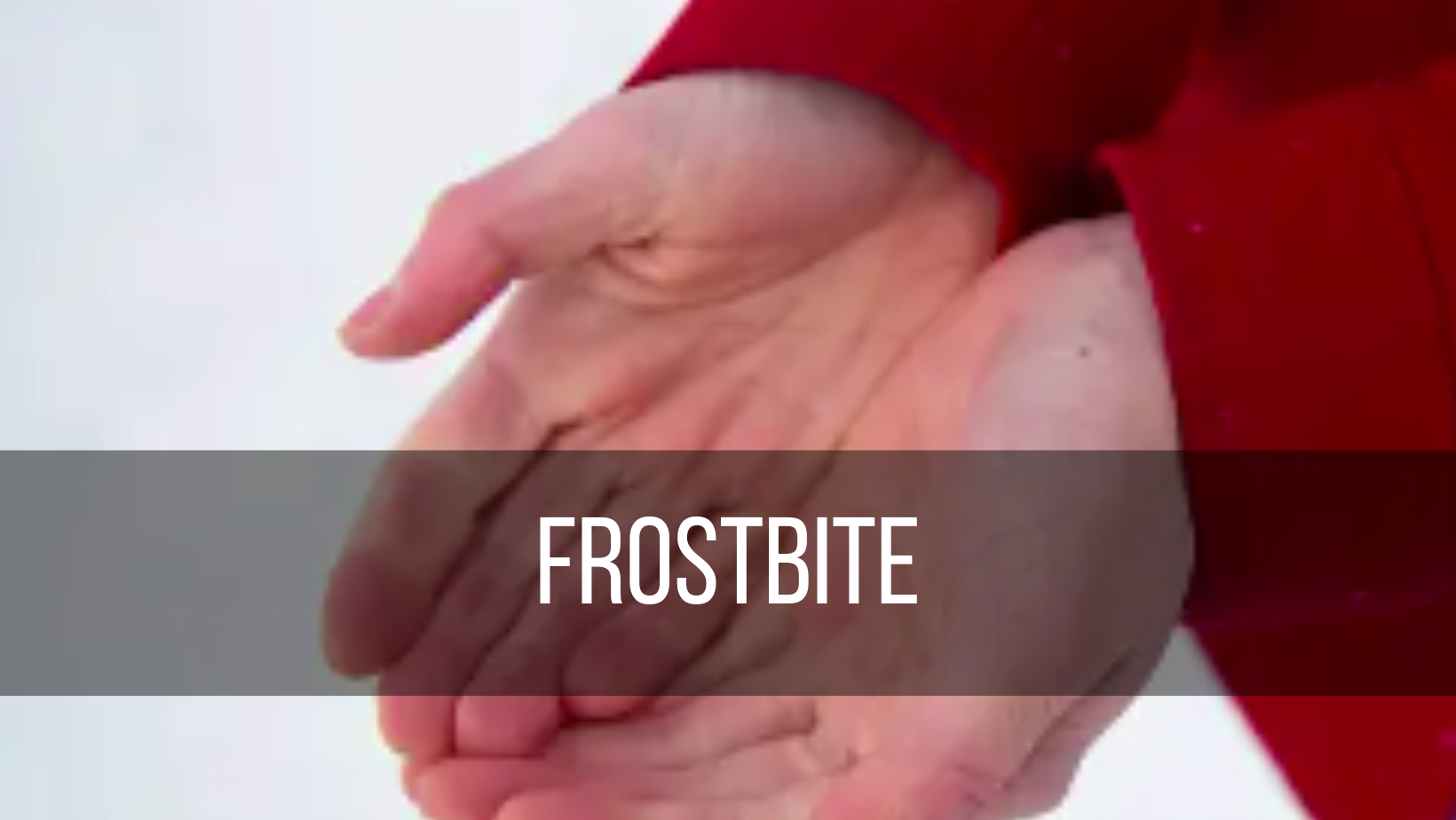 Frostbite: Causes, Symptoms, Treatment, and Prevention
