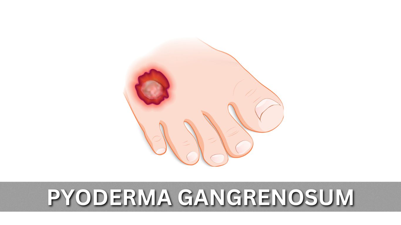 Pyoderma Gangrenosum Causes, Symptoms, Treatment, and More